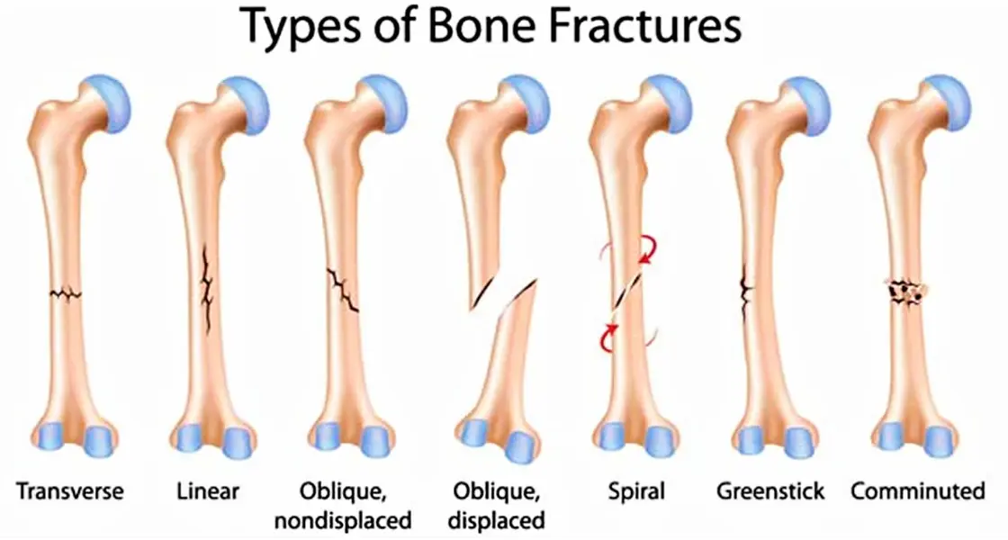 20 Fractures Quiz Questions and Answers