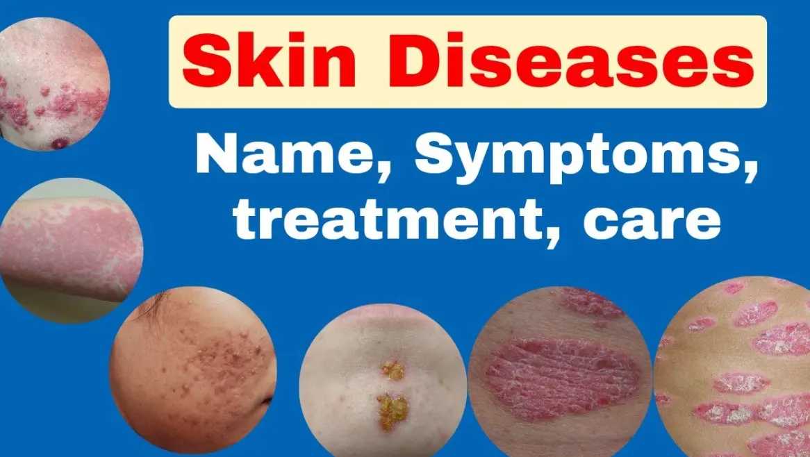 20 Skin Disease Quiz Questions and Answers